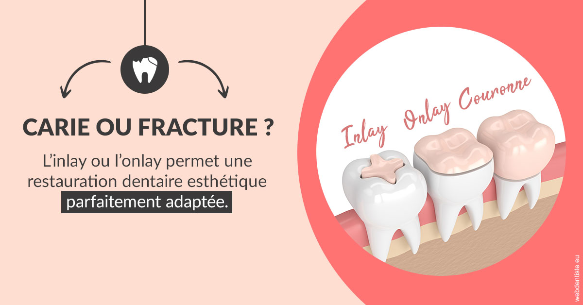 https://dr-virapin-apou-jeanmarc.chirurgiens-dentistes.fr/T2 2023 - Carie ou fracture 2