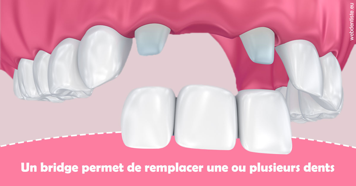 https://dr-virapin-apou-jeanmarc.chirurgiens-dentistes.fr/Bridge remplacer dents 2