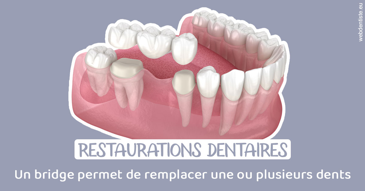 https://dr-virapin-apou-jeanmarc.chirurgiens-dentistes.fr/Bridge remplacer dents 1