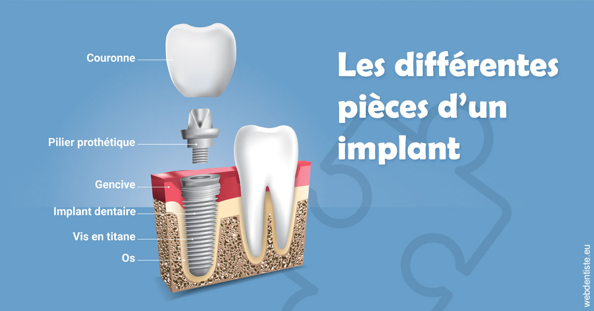 https://dr-virapin-apou-jeanmarc.chirurgiens-dentistes.fr/Les différentes pièces d’un implant 1